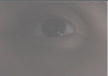 Lower eyelid hollowness showing
