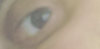 Smiling making hollowness worse; I want this lower eyelid line to blend with skin when smiling (problem is worse on outer corner of eye).