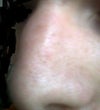 hump in the oblique left view. similar hump in right oblique.