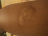 this is how the scar would look like if i stretch my leg.