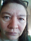 undereyes and forehad.
what can I do outside of surgery?