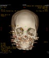 Facial Reconstruction Surgery