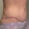 dogear& thick scar thats uncomfortable when i wear tight jeans