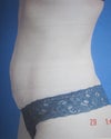 before surgery