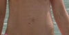 Before hernia repair