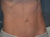 After umbilical hernia repair