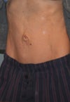 After umbilicoplasty