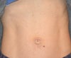 Another taken 1 week after umbilicoplasty