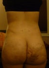 left flank indentation and one cheek bigger and more full than other