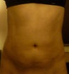 lumpy tummy