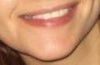 chin asymmetry, smile asymmetry