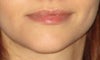 chin asymmetry