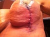 Right side stitching 2 days post op lollipop lift