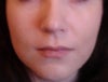 Even though I had always had some asymmetry the cheek has flattened a little since the accident
