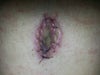 This was at 8 Days Post Op