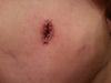 This was at 11 Days Post Op