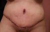 11 Days Post Op..