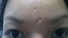 Front view chickenpox scars on forehead between eyebrow