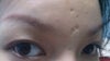 side view chickenpox scars on forehead between eyebrow