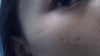 more chickenpox scar on cheeks