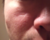 Pre fraxel, area want to treat.