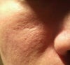 Fraxel after 2 months. No improvement? When treating scar during fraxel, the physician went through my whole right cheek because she said usually treat area around it as well to give better results.