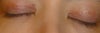 These are the scars .. there is no improvement in them since the day of surgery .. but the redness has gone