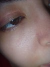 The wrinkles .. can it be treated with laser???