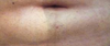 3 weeks post operative Vaser liposuction for upper and lower abdomen. Swelling is shown under the belly button.