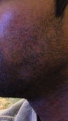 Hyperpigmentation permanent?