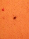 mole on upper back.