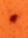 same mole enlarged.