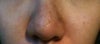 uneven nostirl and nose, supraalar crease, no crease thicker skin on side of nose