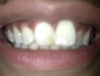 Front teeth