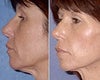 Thread Lift Before and After Photos