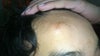 lump/bump