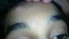 scar in the middle
