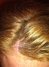 Second spot. No crusting or oozing. Third spot is hard to see. No line skin is not red.