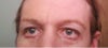 Eyelid Retraction