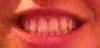 Before - missing incisors