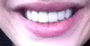 After - Dental Bonding - feel it's too bulky looking