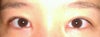 The front part of my left eye's crease is loose and therefore will not go in all the way to the inner corners. The crease lacks reinforcement in that area so the skin bulges out. However, my surgeon says it is due to internal scarring and will get better with time. He refuses to even see me in person and says I am paranoid. Is this true? I definitely feel like the crease is coming undone in this area, and it has only been 4 months since my surgery.