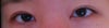 The front part of my left eye's crease is loose and therefore will not go in all the way to the inner corners. The crease lacks reinforcement in that area so the skin bulges out. However, my surgeon says it is due to internal scarring and will get better with time. He refuses to even see me in person and says I am paranoid. Is this true? I definitely feel like the crease is coming undone in this area, and it has only been 4 months since my surgery.