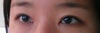 The front part of my left eye's crease is loose and therefore will not go in all the way to the inner corners. The crease lacks reinforcement in that area so the skin bulges out. However, my surgeon says it is due to internal scarring and will get better with time. He refuses to even see me in person and says I am paranoid. Is this true? I definitely feel like the crease is coming undone in this area, and it has only been 4 months since my surgery.