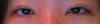 The front part of my left eye's crease is loose and therefore will not go in all the way to the inner corners. The crease lacks reinforcement in that area so the skin bulges out. However, my surgeon says it is due to internal scarring and will get better with time. He refuses to even see me in person and says I am paranoid. Is this true? I definitely feel like the crease is coming undone in this area, and it has only been 4 months since my surgery.
