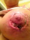 My left breast as of today