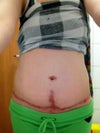 6 months post surgery.