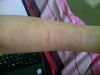 arm after 2nd session laser day2