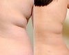 Laser liposuction before & after photos