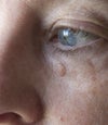 Clear mole under my eye